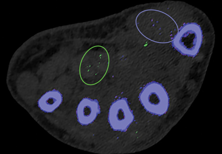 Appropriate kernel selection. MD-urate images of the wrist for gout evaluation with dual-source DECT. (a) Image processed with a bone kernel (Qr59d) shows artifactual green and blue pixels in the soft tissue that would indicate urate and calcium deposits, respectively (colors by default from the vendor). (b) On an image processed correctly with a soft-tissue kernel (Bf32d), these colored pixels have been removed and shown to be artifactual.