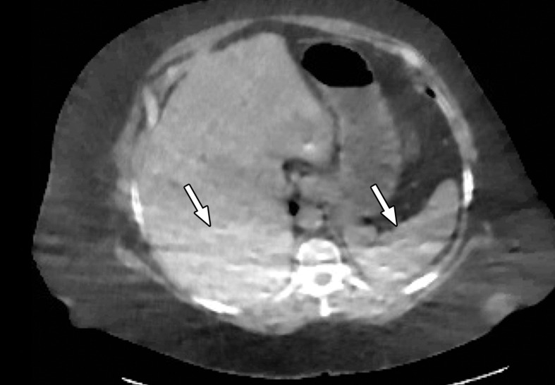 Photon starvation in a large patient. Axial portovenous phase abdominopelvic CT was performed in a 242-lb (110-kg) patient using rapid kilovolt peak (kVp) switching DECT. (a) Material density (MD)–iodine image shows dark bands of artifact (arrows) across the liver and spleen. (b) On an MD-water image, the streaks appear as bright bands (arrows). (c) On a 65 kilo–electron volt (keV) image, the artifacts are much less apparent (arrows). (d) On a 140 kVp–equivalent image, the artifacts are not visualized.