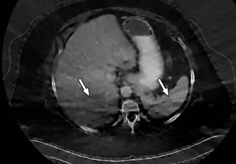 Photon starvation in a large patient. Axial portovenous phase abdominopelvic CT was performed in a 242-lb (110-kg) patient using rapid kilovolt peak (kVp) switching DECT. (a) Material density (MD)–iodine image shows dark bands of artifact (arrows) across the liver and spleen. (b) On an MD-water image, the streaks appear as bright bands (arrows). (c) On a 65 kilo–electron volt (keV) image, the artifacts are much less apparent (arrows). (d) On a 140 kVp–equivalent image, the artifacts are not visualized.