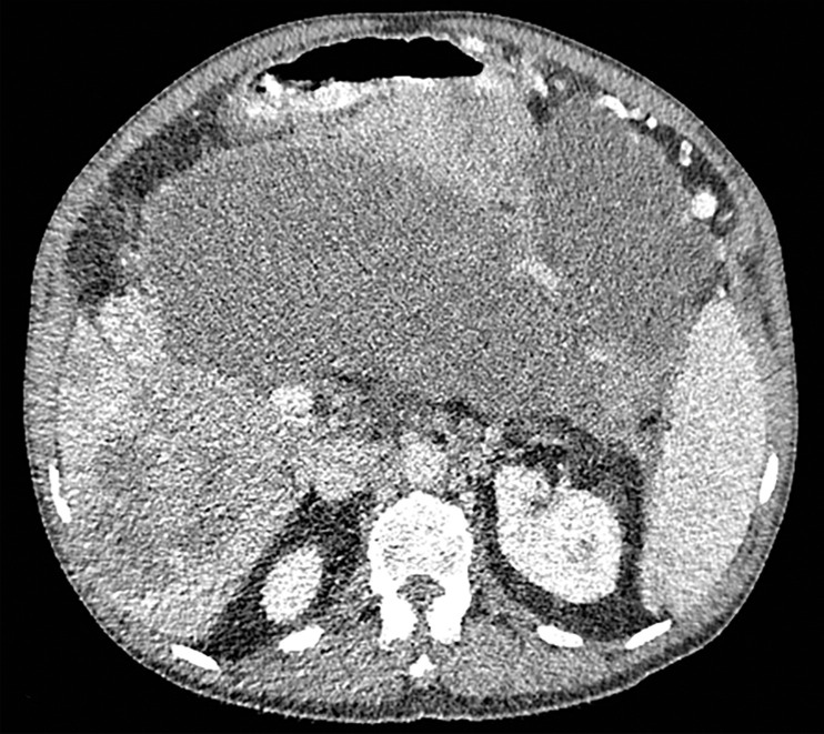 Constrained spectral field of view (FOV). Axial abdominopelvic CT images obtained in a 233-lb (106-kg) patient with a second-generation dual-source DECT scanner. (a, b) Image acquired at 100 kVp (a) has a larger FOV (50 cm) than an image acquired at 140 kVp Sn (33 cm) (b) owing to a difference in associated detector size. (c) Single-energy–equivalent image shows that the high-kVp tube-detector constrains the spectral FOV, which is limited to the area within the dotted circle, and also degrades the image quality of structures that lie outside the spectral FOV (arrows). (d) On a color overlay MD-iodine image, the constrained spectral FOV limits the anatomic area (within the dotted circle) for which qualitative and quantitative material-specific information (eg, iodine distribution) can be obtained. (e) On a virtual noncontrast (VNC) image, the areas outside the spectral FOV (dotted circle) show spurious high attenuation (arrows).