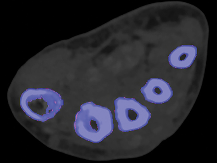 Appropriate kernel selection. MD-urate images of the wrist for gout evaluation with dual-source DECT. (a) Image processed with a bone kernel (Qr59d) shows artifactual green and blue pixels in the soft tissue that would indicate urate and calcium deposits, respectively (colors by default from the vendor). (b) On an image processed correctly with a soft-tissue kernel (Bf32d), these colored pixels have been removed and shown to be artifactual.