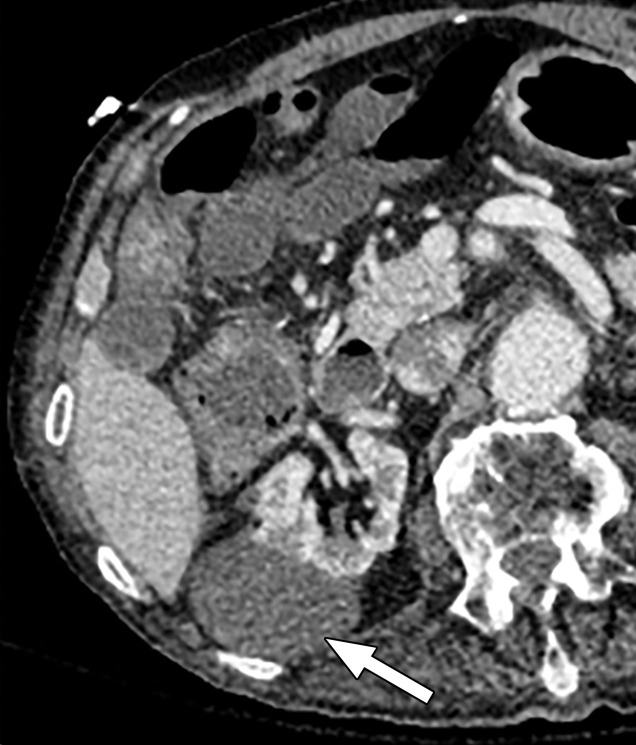 Optimization of window settings for MD-iodine images. (a) Axial single-energy–equivalent image shows a simple fluid-attenuation cyst in the right kidney (arrow). (b) Axial color overlay MD-iodine image shows spurious uptake of iodine (dark red) by the cyst (arrow) due to improper window settings. Also note the false presence of iodine in the gallbladder (*), subcutaneous fat (arrowhead), and air. (c) Axial color overlay MD-iodine image with appropriate window display shows lack of iodine in the cyst (arrow).