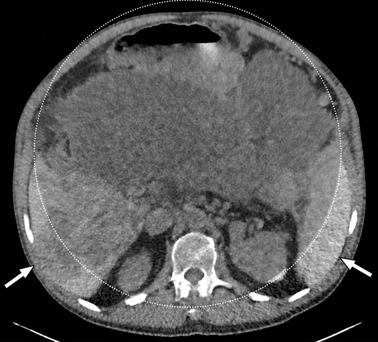 Constrained spectral field of view (FOV). Axial abdominopelvic CT images obtained in a 233-lb (106-kg) patient with a second-generation dual-source DECT scanner. (a, b) Image acquired at 100 kVp (a) has a larger FOV (50 cm) than an image acquired at 140 kVp Sn (33 cm) (b) owing to a difference in associated detector size. (c) Single-energy–equivalent image shows that the high-kVp tube-detector constrains the spectral FOV, which is limited to the area within the dotted circle, and also degrades the image quality of structures that lie outside the spectral FOV (arrows). (d) On a color overlay MD-iodine image, the constrained spectral FOV limits the anatomic area (within the dotted circle) for which qualitative and quantitative material-specific information (eg, iodine distribution) can be obtained. (e) On a virtual noncontrast (VNC) image, the areas outside the spectral FOV (dotted circle) show spurious high attenuation (arrows).