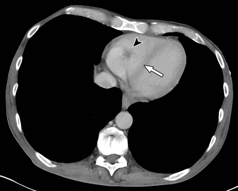 Temporal misregistration on images obtained with dual-source DECT. (a) Axial pulmonary CT angiogram from the 150-kVp Sn projection shows a subtle filling defect (arrowhead) in the right ventricle (arrow). (b) Axial single-energy–equivalent pulmonary CT angiogram, which contains projections from both voltages, shows no filling defect in the right ventricle (arrow). (c) Axial single-energy (120-kVp) abdominal CT image obtained on the same day clearly shows a filling defect (arrowhead) in the right ventricle (arrow). (d) Echocardiogram shows a thrombus (arrowhead) in the right ventricle (arrow). Nonvisualization of the thrombus at DECT was due to temporal offset between the two x-ray tubes.