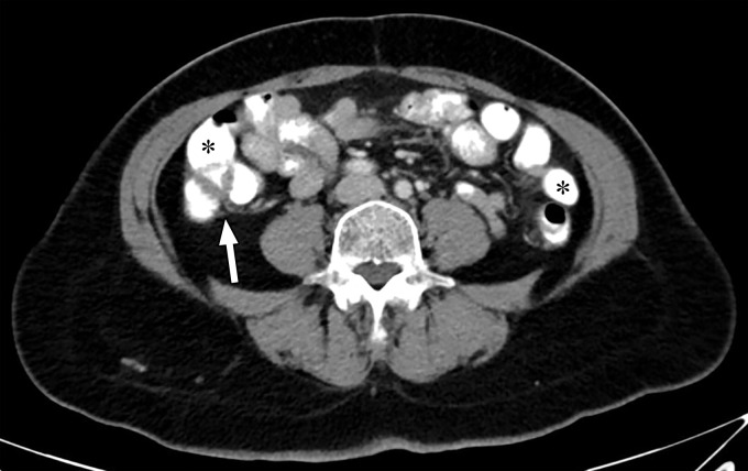 Optimization of window settings for virtual monochromatic (VMC) images. Axial portovenous phase abdominopelvic CT images obtained with iodinated oral contrast medium (*) show the bowel wall and folds (arrow). (a) A 120-kVp image at window width (WW) of 360 HU and window level (WL) of 60 HU. (b) A 40-keV VMC image at the same window settings shows significant "blooming" of contrast medium, hindering visualization of the bowel wall and folds. (c) A 40-keV VMC image at wider window settings (WW = 589 HU, WL = 88 HU) provides optimal display.