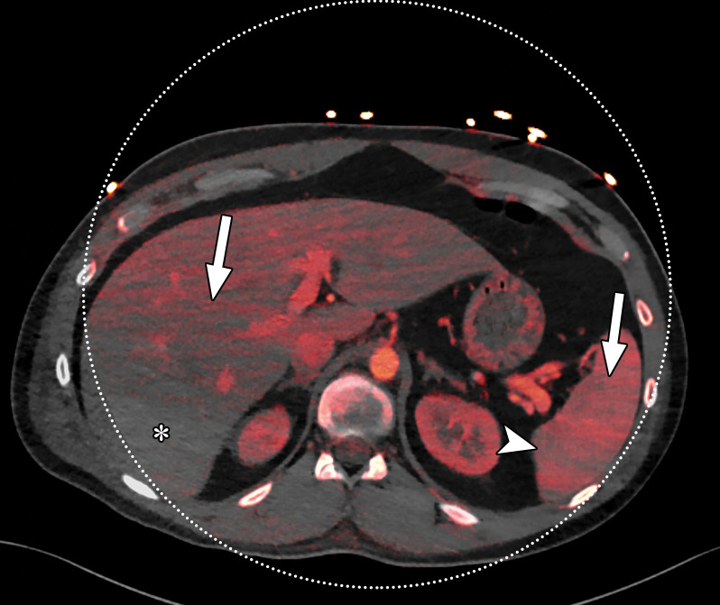 Beam hardening due to arm positioning. (a) Topographic image obtained for abdominopelvic CT with a dual-source scanner, which processes DECT images in the image domain, shows that the patient was scanned in the "right arm down" position. (b) Axial single-energy–equivalent image shows dark streaks (arrows) emanating from the humerus that extend across the liver and spleen. Dotted circle = spectral FOV. (c) On an axial color overlay MD-iodine image, the streaks (arrows) also affect depiction of iodine distribution. Even though the posterior hepatic segment (*) and spleen (arrowhead) lie within the spectral FOV (dotted circle), they artifactually show lack of iodine uptake, which can mimic a parenchymal infarct.