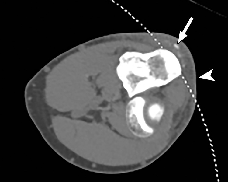 Constrained spectral FOV for small parts. Axial single-energy–equivalent image of the elbow obtained with a dual-source DECT scanner. Soft-tissue mineralization (arrow) associated with soft-tissue swelling (olecranon bursitis) (arrowhead) along the posterior aspect of the elbow lies outside the spectral FOV (dotted curved line). Therefore, material analysis for characterizing the mineralization as gouty deposits is not possible.