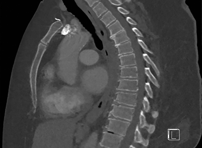 Importance of protocol selection. Sagittal single-energy–equivalent CT images of the thorax in a 280-lb (127-kg) patient, obtained with dual-source DECT at the same window display setting at two time points. The images were acquired at tube voltages of 80/140 kVp tin filter (Sn) (volumetric CT dose index = 10 mGy) (a) and 100/150 kVp Sn (volumetric CT dose index = 25 mGy) (b). Image quality is superior in b compared with in a owing to improved photon flux and penetration, at the expense of higher radiation dose.