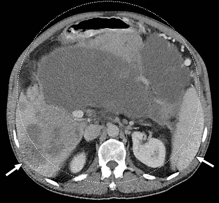 Constrained spectral field of view (FOV). Axial abdominopelvic CT images obtained in a 233-lb (106-kg) patient with a second-generation dual-source DECT scanner. (a, b) Image acquired at 100 kVp (a) has a larger FOV (50 cm) than an image acquired at 140 kVp Sn (33 cm) (b) owing to a difference in associated detector size. (c) Single-energy–equivalent image shows that the high-kVp tube-detector constrains the spectral FOV, which is limited to the area within the dotted circle, and also degrades the image quality of structures that lie outside the spectral FOV (arrows). (d) On a color overlay MD-iodine image, the constrained spectral FOV limits the anatomic area (within the dotted circle) for which qualitative and quantitative material-specific information (eg, iodine distribution) can be obtained. (e) On a virtual noncontrast (VNC) image, the areas outside the spectral FOV (dotted circle) show spurious high attenuation (arrows).