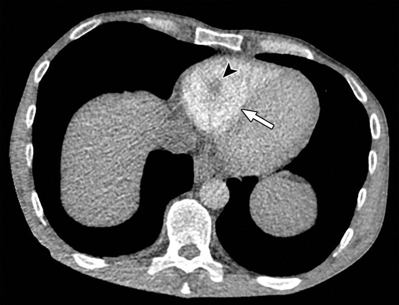 Temporal misregistration on images obtained with dual-source DECT. (a) Axial pulmonary CT angiogram from the 150-kVp Sn projection shows a subtle filling defect (arrowhead) in the right ventricle (arrow). (b) Axial single-energy–equivalent pulmonary CT angiogram, which contains projections from both voltages, shows no filling defect in the right ventricle (arrow). (c) Axial single-energy (120-kVp) abdominal CT image obtained on the same day clearly shows a filling defect (arrowhead) in the right ventricle (arrow). (d) Echocardiogram shows a thrombus (arrowhead) in the right ventricle (arrow). Nonvisualization of the thrombus at DECT was due to temporal offset between the two x-ray tubes.