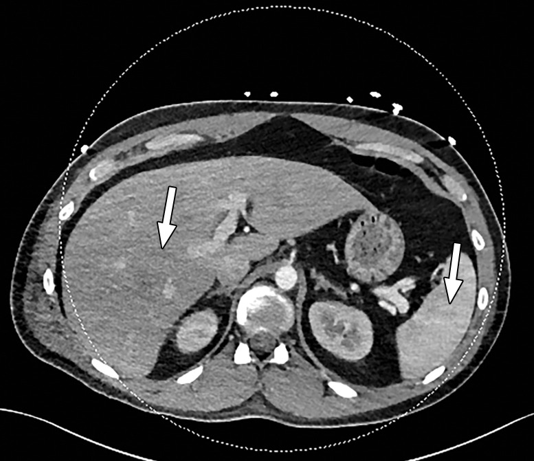 Beam hardening due to arm positioning. (a) Topographic image obtained for abdominopelvic CT with a dual-source scanner, which processes DECT images in the image domain, shows that the patient was scanned in the "right arm down" position. (b) Axial single-energy–equivalent image shows dark streaks (arrows) emanating from the humerus that extend across the liver and spleen. Dotted circle = spectral FOV. (c) On an axial color overlay MD-iodine image, the streaks (arrows) also affect depiction of iodine distribution. Even though the posterior hepatic segment (*) and spleen (arrowhead) lie within the spectral FOV (dotted circle), they artifactually show lack of iodine uptake, which can mimic a parenchymal infarct.