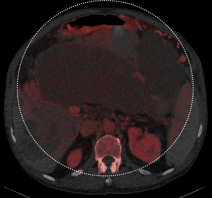 Constrained spectral field of view (FOV). Axial abdominopelvic CT images obtained in a 233-lb (106-kg) patient with a second-generation dual-source DECT scanner. (a, b) Image acquired at 100 kVp (a) has a larger FOV (50 cm) than an image acquired at 140 kVp Sn (33 cm) (b) owing to a difference in associated detector size. (c) Single-energy–equivalent image shows that the high-kVp tube-detector constrains the spectral FOV, which is limited to the area within the dotted circle, and also degrades the image quality of structures that lie outside the spectral FOV (arrows). (d) On a color overlay MD-iodine image, the constrained spectral FOV limits the anatomic area (within the dotted circle) for which qualitative and quantitative material-specific information (eg, iodine distribution) can be obtained. (e) On a virtual noncontrast (VNC) image, the areas outside the spectral FOV (dotted circle) show spurious high attenuation (arrows).