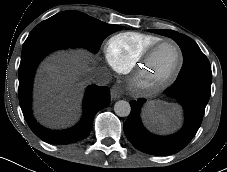 Temporal misregistration on images obtained with dual-source DECT. (a) Axial pulmonary CT angiogram from the 150-kVp Sn projection shows a subtle filling defect (arrowhead) in the right ventricle (arrow). (b) Axial single-energy–equivalent pulmonary CT angiogram, which contains projections from both voltages, shows no filling defect in the right ventricle (arrow). (c) Axial single-energy (120-kVp) abdominal CT image obtained on the same day clearly shows a filling defect (arrowhead) in the right ventricle (arrow). (d) Echocardiogram shows a thrombus (arrowhead) in the right ventricle (arrow). Nonvisualization of the thrombus at DECT was due to temporal offset between the two x-ray tubes.