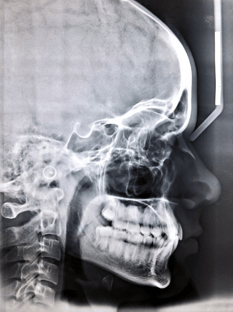 Clinical Management of Dewey’s Type 3 Anterior Crossbite in Angle Class ...