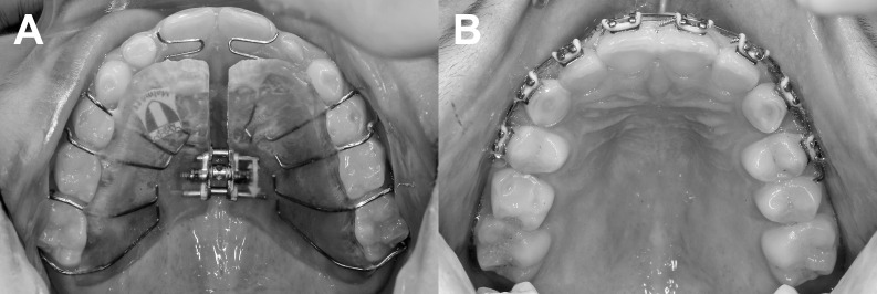 Figure 3. Occlusal view of (A) the removable orthodontic appliance and (B) the fixed orthodontic appliance. The lateral occlusal coverage of the removable appliance has just been removed because the maxillary incisors were the in correct position and the anterior crossbite was corrected. Also, the expansion screw has been activated during the treatment because it was judged to comply with the natural transverse growth of the jaw.