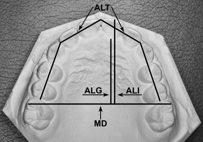 Figure 2. Sagittal and transverse measurements made on the maxillary study casts. For definitions of the different variables, see the list of outcome measures in the Materials and Methods section.