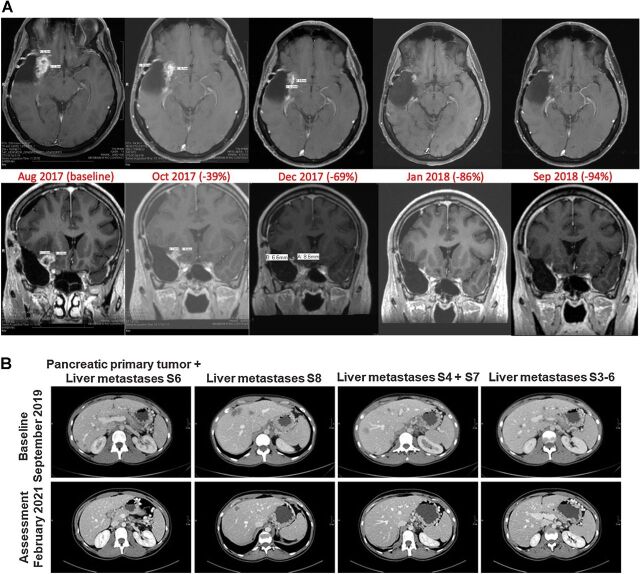 Figure 2. A, MRI images of a 53-year-old male diagnosed with IDH WT grade 4 glioma with EGFR P772_V774dupPHV mutation, CDK4 amplification, and methylated MGMT promoter gene enrolled to this study after multiple tumor resections and no clinical benefit with concurrent radiotherapy and chemotherapy, including temozolomide and lomustine. He had a 94% tumor reduction by RANO assessment on LY3200882 monotherapy at 50 mg twice a day (2w/2w schedule), with no clinical toxicities, and remained on trial approximately 2 years. B, CT scans of patient with pancreatic cancer, after 18 months of treatment with LY3200882+gemcitabine+nab-paclitaxel. A complete response of liver metastases in S6, S4 and 7, and S3–6 was achieved. Primary pancreatic tumor obtained a 40% reduction of its longest diameter. Liver metastasis in S8 achieved a 58% reduction of its longest diameter.