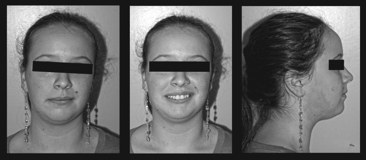 Figure 1. Pretreatment extraoral photographs.