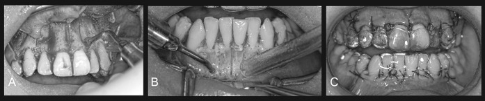 Figure 6. Modified alveolar corticotomy. Vertical cuts (A) and small round perforations (B) are made using piezosurgical device following only mucoperiosteal buccal flap. The clear aligner applied on the teeth immediately after surgery (C).