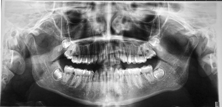 Figure 5. Pretreatment panoramic radiograph.