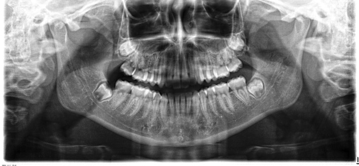 Figure 10. Posttreatment panoramic radiograph.