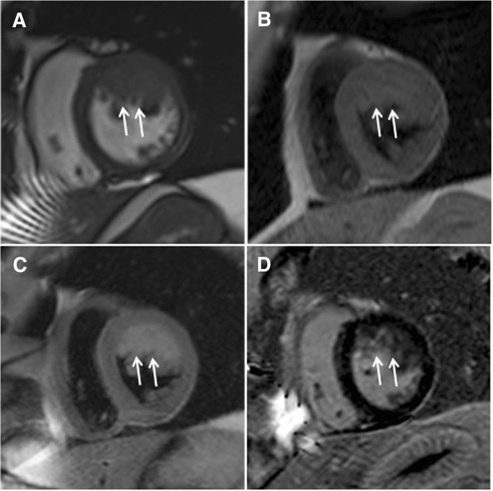 Multidisciplinary approach to rare primary cardiac sarcoma: a case ...