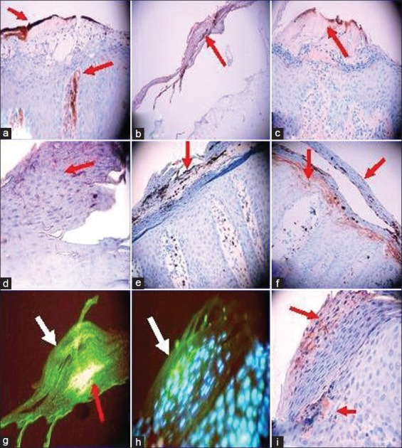 Immune Reactivity in Psoriatic Munro-Saboureau Microabscesses, Stratum ...