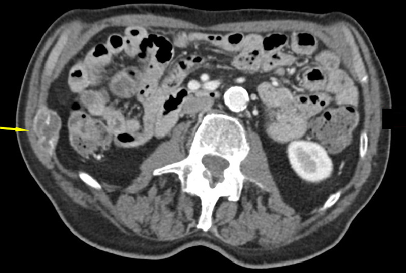 CT images in an 82-year-old man show tumor (a) before, (b) during, and (c) after cryoablation. (a) Yellow arrow shows metastatic leiomyosarcoma (right 11th rib lesion). (b) Yellow arrows around low-attenuation ice ball. Red arrow is CO2 displacement of the adjacent bowel. (c) Image from 14-month follow-up CT examination demonstrates no disease progression in tumor (yellow arrows).