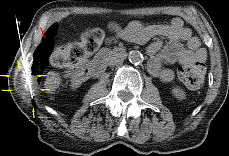 CT images in an 82-year-old man show tumor (a) before, (b) during, and (c) after cryoablation. (a) Yellow arrow shows metastatic leiomyosarcoma (right 11th rib lesion). (b) Yellow arrows around low-attenuation ice ball. Red arrow is CO2 displacement of the adjacent bowel. (c) Image from 14-month follow-up CT examination demonstrates no disease progression in tumor (yellow arrows).