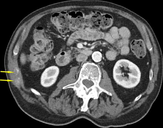 CT images in an 82-year-old man show tumor (a) before, (b) during, and (c) after cryoablation. (a) Yellow arrow shows metastatic leiomyosarcoma (right 11th rib lesion). (b) Yellow arrows around low-attenuation ice ball. Red arrow is CO2 displacement of the adjacent bowel. (c) Image from 14-month follow-up CT examination demonstrates no disease progression in tumor (yellow arrows).