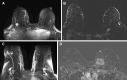 Examples of MRI in the patient cohort. (A) Preoperative
contrast-enhanced axial MR image in a White patient (70-year-old female) who
had negative margins at surgery, showing an enhancing mass in the right
breast, upper outer quadrant, posterior depth. (B) Preoperative
contrast-enhanced axial MR image in a Black patient (60-year-old female) who
had negative margins at surgery, showing focal nonmass enhancement in the
left breast, upper inner quadrant, posterior depth. (C) Preoperative
contrast-enhanced axial MR image in a White patient (73-year-old female) who
had positive margins at surgery, showing two enhancing masses in the right
outer breast, anterior and posterior depths. (D) Preoperative
contrast-enhanced axial MR subtraction image in a Black patient (44-year-old
female) who had positive margins at surgery, showing an irregular enhancing
mass with an in situ biopsy marker denoting site of carcinoma.