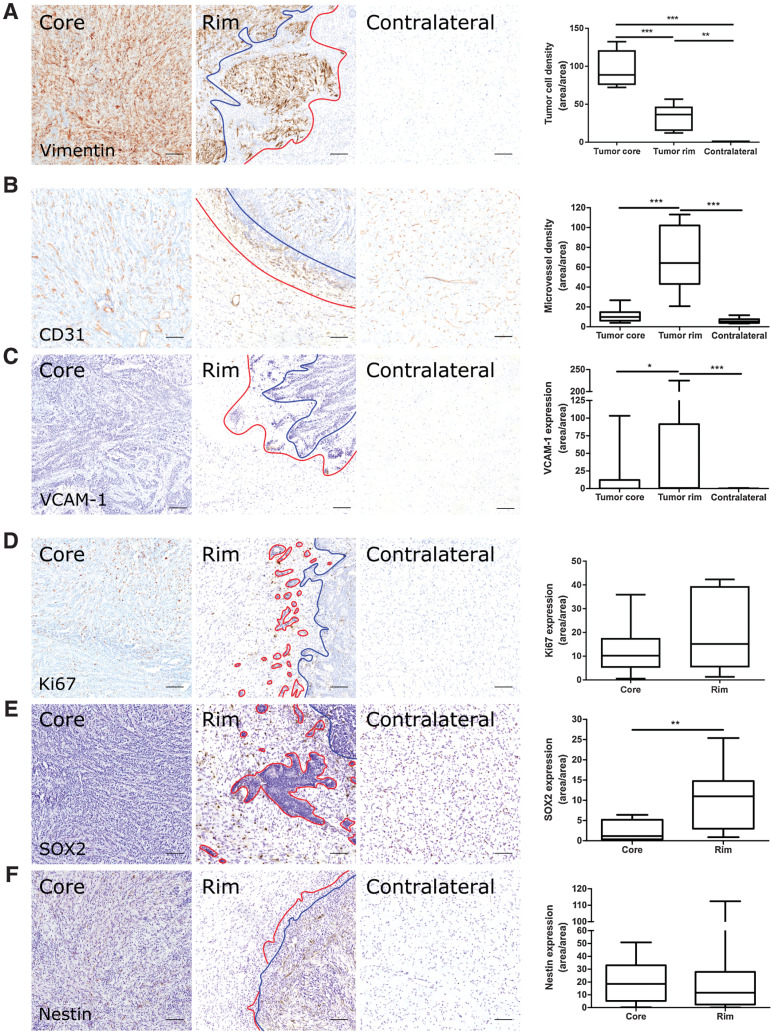 Figure 2. Microvascular and tumor cell biology at the tumor rim in U87MG glioblastoma. Representative histologic sections of rat brains, intrastriatally injected with U87MG tumor cells, from the tumor core, tumor rim, and the contralateral striatum, with corresponding box and whisker plots of marker expression in each region. Data shown as median ± interquartile range. Sections were immunohistochemically stained (brown) for tumor cell marker vimentin (A), endothelial marker CD31 (B), cell adhesion molecule VCAM-1 (C), cell proliferation marker Ki67 (D), and two stemness markers: SOX2 (E) and nestin (F). Scale bar = 100 μm. *, P < 0.05; **, P < 0.01; ***, P < 0.001; n = 5; post hoc Bonferroni multiple comparison test for tumor cell density and microvessel density, and post hoc Dunn test for VCAM-1 expression. Tumor core was delineated from the infiltrative border as indicated by the blue and red lines, respectively. Expression of Ki67, nestin, and SOX2 has been normalized to tumor area. **, P < 0.01; matched Wilcoxon test.