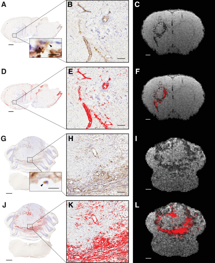 Figure 5. Spatial colocalization of VCAM-1 and VCAM-MPIO–induced hypointensities in metastasis and medulloblastoma models. Representative images from a MDA231Br-GFP tumor-bearing animal (A–F) and a DAOY medulloblastoma animal (G–L). Positive VCAM-1 expression (brown) is evident on the endothelium of vessels at the margins of both the MDA231Br tumor (A and D) and the DAOY tumor (G and J); cresyl violet counterstain (blue). Scale bar = 1 mm. Inset images in A and G illustrate presence of VCAM-MPIO beads (black arrowhead) bound to the luminal surface of VCAM-1–positive vessels (brown); scale bar = 10 μm. (B, E, H, and K, Corresponding high-powered magnification images from boxes; scale bar = 100 µm. D, E, J, and K, Areas segmented as VCAM-1 positive are highlighted in red. Note, in A and D nonspecific staining of the ventricles and tissue edges is evident, which has not been removed from the analysis for transparency, but does not reflect true endothelial VCAM-1 staining. C, F, I, and L, Corresponding T2*-weighted MRI slices showing VCAM-MPIO–induced hypointensities either alone (C and I), or with an overlay (red) showing perspective transformed histology derived VCAM-1 staining (F and L); scale bar = 1 mm.