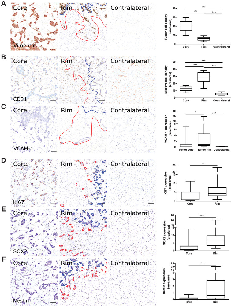 Figure 1. Microvascular and tumor cell biology at the tumor rim in MDA231Br-GFP brain metastases. Representative histologic sections of rat brains, intrastriatally injected with MDA231Br-GFP tumor cells, from the tumor core, tumor rim, and the contralateral striatum, with corresponding box and whisker plots of marker expression in each region. Data shown as median ± interquartile range. Sections were immunohistochemically stained (brown) for tumor cell marker vimentin (A), endothelial marker CD31 (B), cell adhesion molecule VCAM-1 (C), cell proliferation marker Ki67 (D), and two stemness markers: SOX2 (E) and nestin (F). Scale bar = 100 μm. *, P < 0.05; ***, P < 0.001; n = 8; post hoc Bonferroni multiple comparison test for tumor cell density and microvessel density, and post hoc Dunn test for VCAM-1 expression. Tumor core was delineated from the infiltrative border as indicated by the blue and red lines, respectively. Expression of Ki67, nestin and SOX2 has been normalized to tumor area. *, P < 0.05; ***, P < 0.001; matched Wilcoxon test.