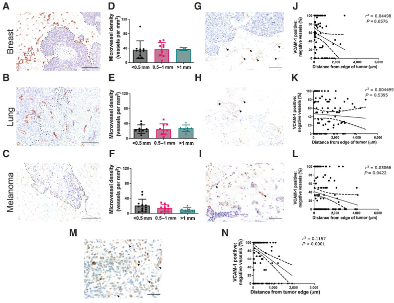 Figure 6. Peritumoral vasculature is characterized by upregulated endothelial VCAM-1 expression. Representative histologic sections of peritumoral brain tissue, from breast cancer (A), lung adenocarcinoma (B), and melanoma brain metastases (C) immunohistochemically stained for the endothelial marker, CD34 (brown); scale bar = 200 μm, black dashed line outlines tumor border. D–F, Corresponding graphs showing mean microvessel density (± SD) in the peri-tumoral brain parenchyma in the following regions: < 0.5 mm, 0.5–1 mm, and > 1 mm from the metastasis border; n = 10 (breast), n = 9 (lung), and n = 12 (melanoma). G–I, Images showing endothelial VCAM-1 expression (arrowheads) associated with the metastasis from the same patients as above; scale bar = 100 μm. J–L, Corresponding graphs showing ratio of VCAM-1–positive/negative vessels in randomly distributed square ROIs across the peritumoral brain parenchyma. M, Representative image of endothelial VCAM-1 expression at the border of a glioblastoma, with corresponding graph of VCAM-1–positive/negative vessel distribution (N); scale bar = 100 μm.