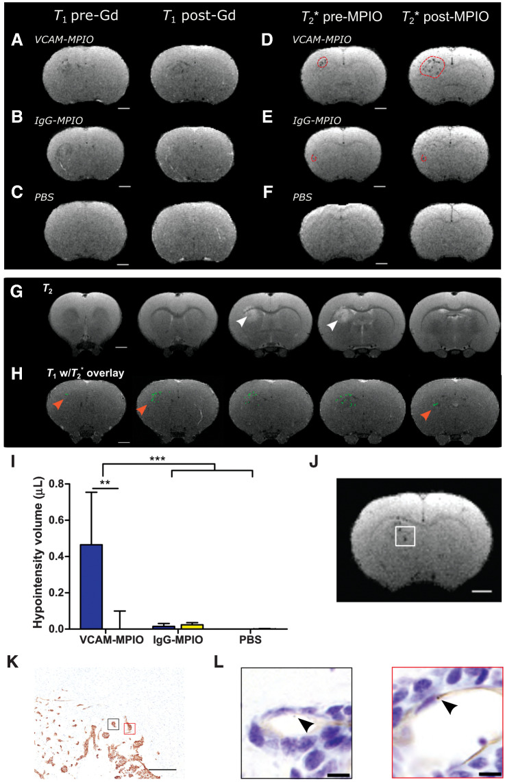 Figure 3. Anti-VCAM-1–targeted MRI reveals tumor margins in MDA231Br-GFP brain metastases. Pre-/post-gadolinium T1-weighted images from rat brains either with intrastriatal MDA231Br-GFP tumors (A and B) or injected intrastriatally with PBS (C). Matched pre-/post-MPIO T2*-weighted images from the same anatomic locations and same animals as for A and B, injected intravenously with either VCAM-MPIO contrast (D), or IgG-MPIO (E). F, Pre-/post-MPIO T2*-weighted images from a rat injected intrastriatally with PBS and VCAM-MPIO intravenously. Dashed red line encircles visible hypointense regions. G, T2-weighted images showing areas of tumor-associated hyperintensity (white arrowhead). H, Representative MR images of MDA231Br-GFP tumor-bearing rat brain with hypointensities (green pixels) from T2*-weighted imaging overlaid on contrast-enhanced T1-weighted imaging. Note the green pixels extend into regions of the striatum with no associated T2 hyperintensity (red arrowheads). Scale bar = 2 mm. I, Graph showing volumes of hypointensities post-T2*-weighted MRI; data shown as mean ± SD, blue = ipsilateral striatum, yellow = contralateral striatum. **, P < 0.01; ***, P < 0.001; post hoc Tukey test (n = 8 MDA231Br-GFP groups and n = 3 PBS group). J, Representative T2*-weighted MR image slice of a MDA231Br-GFP tumor, with white box highlighting the invasive tumor margin confirmed histologically (K); scale bar = 500 μm. L, Corresponding high-power magnification of highlighted regions of interest (black and red boxes) from stained adjacent sections, demonstrating bound VCAM-MPIO beads (black arrowhead/brown spheres) in a VCAM-1–positive vessel lumen (brown); scale bar = 10 μm.