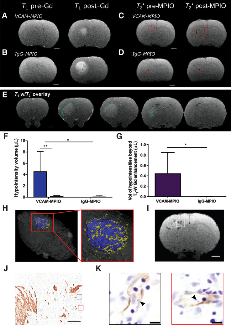 Figure 4. Anti-VCAM-1–targeted MRI reveals tumor margins in U87MG brain tumors. A and B, Pre-/post-gadolinium T1-weighted images from rat brains with intrastriatal U87MG tumors. Matched pre-/post-MPIO T2*-weighted images from rat brains with intrastriatal U87MG tumors, injected intravenously with VCAM-MPIO (C) or IgG-MPIO (D); dashed red line encircles visible hypointense regions. Scale bar = 2 mm. E, Representative images from U87MG tumor-bearing rat brain with hypointensities (green pixels) from T2*-weighted images overlaid on contrast-enhanced T1-weighted images. Scale bar = 2 mm. F, Graph showing volumes of hypointensities post-T2*-weighted MRI; data shown as mean ± SD, blue = ipsilateral striatum, yellow = contralateral striatum. *, P < 0.05; **, P < 0.01; post hoc Tukey test (n = 5 per group). G, Graph showing volume of MPIO-induced hypointensities beyond the border of gadolinium enhancement for rats injected with either VCAM-MPIO or IgG-MPIO. *, P < 0.05; Student t test. H, Pseudocolored three-dimensional reconstruction of imaged animal brain, with coregistration of post-VCAM-MPIO T2*-weighted and contrast-enhanced T1-weighted images; blue = gadolinium enhanced region and yellow = T2* hypointensities. I, Representative T2*-weighted MR image slice of an U87MG tumor, with white box highlighting the invasive tumor margin confirmed histologically (J); scale bar = 500 μm. K, Corresponding high-power magnification of highlighted regions of interest (black and red boxes) from stained adjacent sections, demonstrating bound VCAM-MPIO beads (black arrowhead/brown spheres) in a VCAM-1–positive vessel lumen (brown); scale bar = 10 μm.