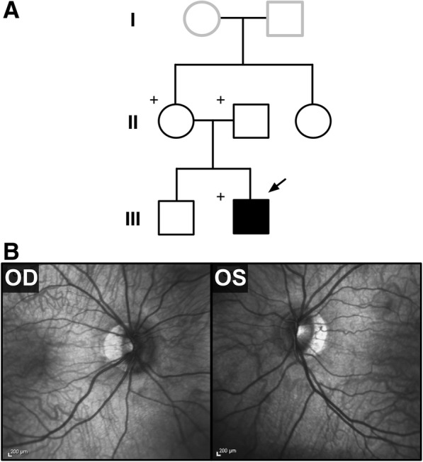 Missense mutation in SLIT2 associated with congenital myopia ...