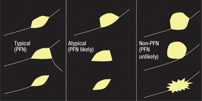 Visual guidelines on classifying a nodule as a PFN according to de Hoop et al (32). A typical PFN was defined as “[a] fissure-attached, homogeneous, solid nodule that had smooth margins and an oval, lentiform, or triangular shape.” Atypical PFNs “either met all [typical PFN] features but were not attached to a fissure or were fissure-attached nodules, convex on one side and rounded on the other.” (Reprinted, with permission, from reference 32). PFN = perifissural nodule.