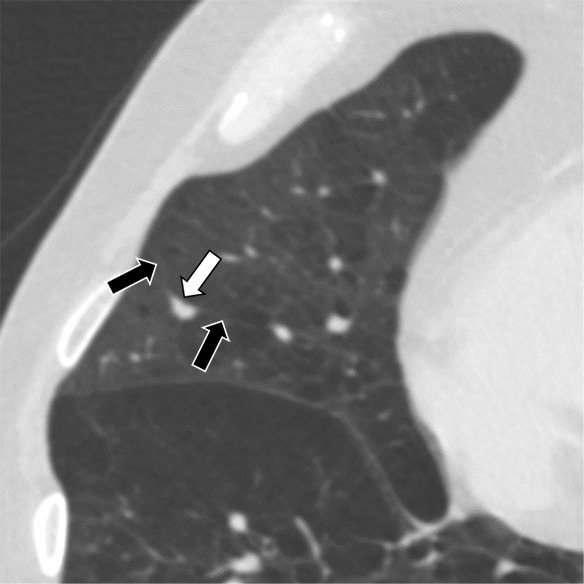 Three CT views of a nodule classified as a perifissural nodule. The shape is flat and/or oval in the (a) axial and (b) coronal planes and polygonal in the (c) sagittal plane. The nodule curves with the minor or accessory fissure. The white arrows point at the nodule; the black arrows point at the attached fissure.