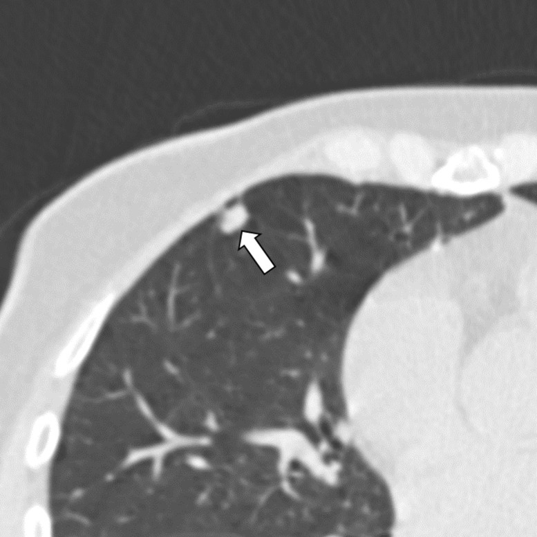 Three CT views of a nodule classified as a perifissural nodule. The shape is oval and/or polygonal, lentiform, and triangular in the (a) axial, (b) coronal, and (c) sagittal planes, respectively. It is located juxtapleurally but not perifissurally; this is a limitation to the term perifissural nodule. The white arrows point at the nodule.