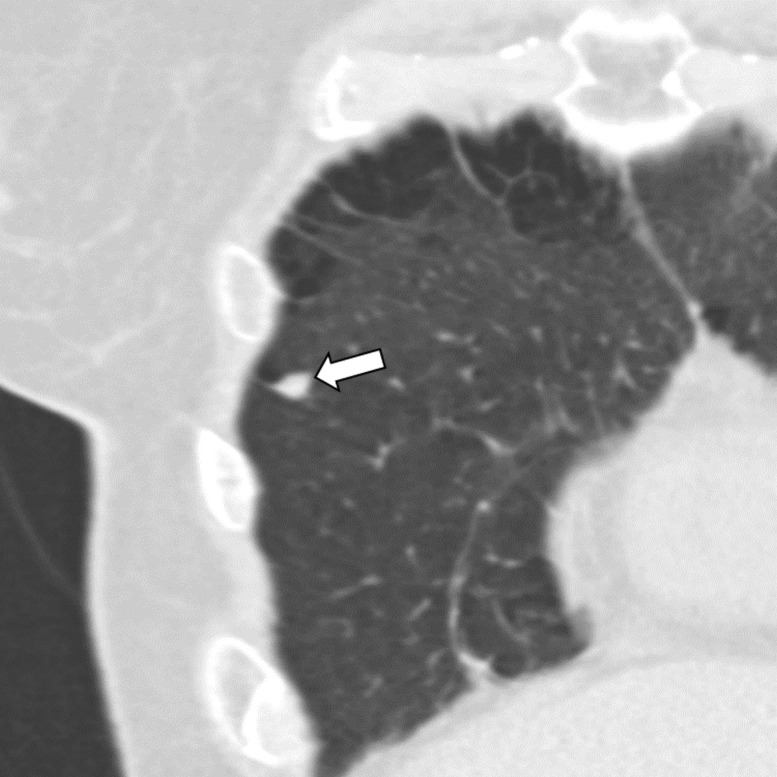 Three CT views of a nodule classified as a perifissural nodule. The shape is oval and/or polygonal, lentiform, and triangular in the (a) axial, (b) coronal, and (c) sagittal planes, respectively. It is located juxtapleurally but not perifissurally; this is a limitation to the term perifissural nodule. The white arrows point at the nodule.