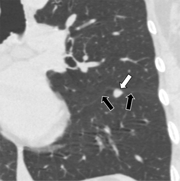 Three CT views of a nodule classified as a perifissural nodule. The shape is triangular in the (a) axial plane, triangular and/or round in the (b) coronal plane, and oval and/or lentiform in the (c) sagittal plane. The major fissure is not influenced by the nodule. The white arrows point at the nodule; the black arrows point at the attached fissure.