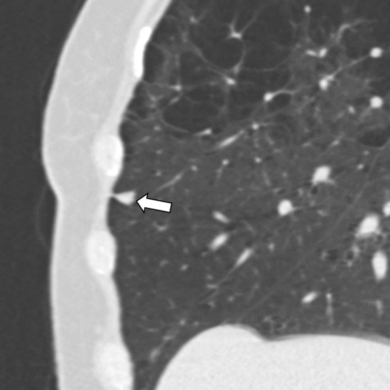 Three CT views of a nodule classified as a perifissural nodule. The shape is oval and/or polygonal, lentiform, and triangular in the (a) axial, (b) coronal, and (c) sagittal planes, respectively. It is located juxtapleurally but not perifissurally; this is a limitation to the term perifissural nodule. The white arrows point at the nodule.