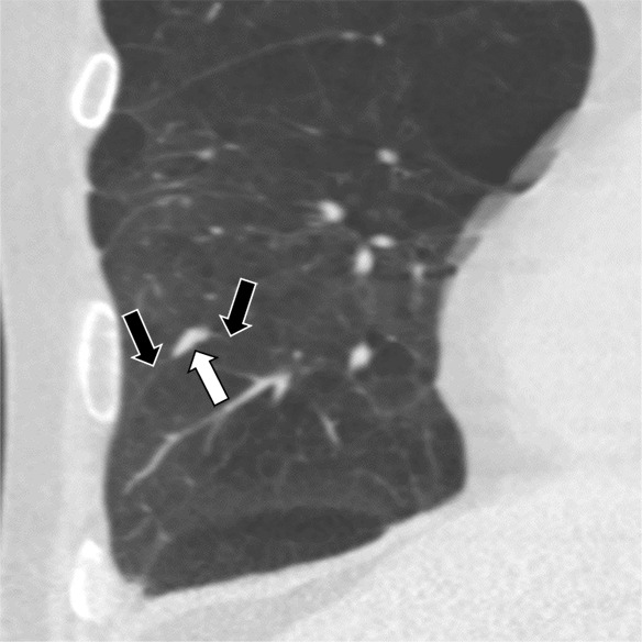 Three CT views of a nodule classified as a perifissural nodule. The shape is flat and/or oval in the (a) axial and (b) coronal planes and polygonal in the (c) sagittal plane. The nodule curves with the minor or accessory fissure. The white arrows point at the nodule; the black arrows point at the attached fissure.