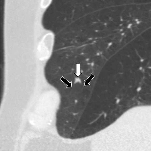 Three CT views of a nodule classified as a perifissural nodule. The shape is flat and/or oval in the (a) axial and (b) coronal planes and polygonal in the (c) sagittal plane. The nodule curves with the minor or accessory fissure. The white arrows point at the nodule; the black arrows point at the attached fissure.