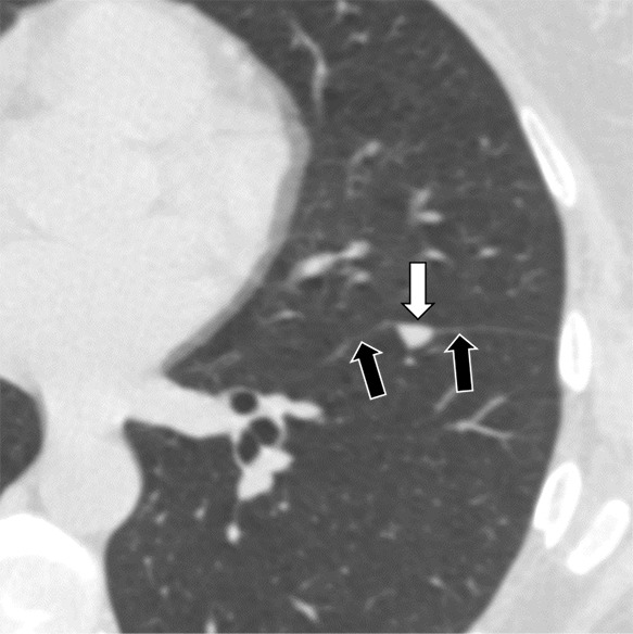 Three CT views of a nodule classified as a perifissural nodule. The shape is triangular in the (a) axial plane, triangular and/or round in the (b) coronal plane, and oval and/or lentiform in the (c) sagittal plane. The major fissure is not influenced by the nodule. The white arrows point at the nodule; the black arrows point at the attached fissure.