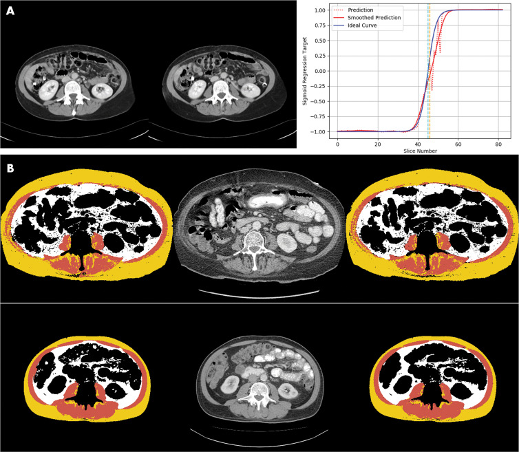 Images demonstrate examples of model output for deep learning body composition pipeline. A, Examples of automated slice selection. The left CT slice was automatically selected by the model; the right CT slice was selected by a radiologist. Graph shows output of L3 regression model. Two vertical lines represent slices selected by radiologist (light blue) and by algorithm (orange). Dotted red line is unfiltered prediction; fluctuations in this curve correspond to adjacent vertebral levels. Zero crossing of filtered prediction is chosen as L3 level by algorithm (solid red line). B, Two examples of automated segmentation results, one per row. Left image shows automated segmentation by the model, the middle image is the input CT slice, and the right image is manually segmented ground truth produced by the radiologist. Color interpretation for segmentation masks are as follows: background or other, black; skeletal muscle, brown; subcutaneous fat, yellow; and visceral fat, white.