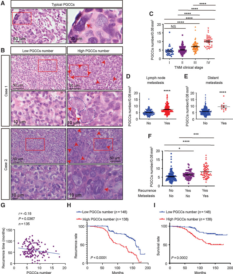 Figure 6. Presence and clinical significance of PGCCs in NPC. A, Representative hematoxylin and eosin staining of typical PGCCs in NPC tissue sections. B, Representative image of PGCCs in NPC tissue microarrays. C–F, PGCC number in different clinical stages (C), lymph node metastases (D), distant metastases (E), and recurrence (F). G, Pearson correlation between recurrence time and PGCC number (linear regression). H and I, Kaplan–Meier analysis was used to compare overall recurrence (H) and overall survival (log-rank test; I). All data represent the mean ± SEM of at least three independent experiments. P values were calculated using one-way ANOVA. *, P < 0.05; ***, P < 0.001; ****, P < 0.0001; NS, not significant.