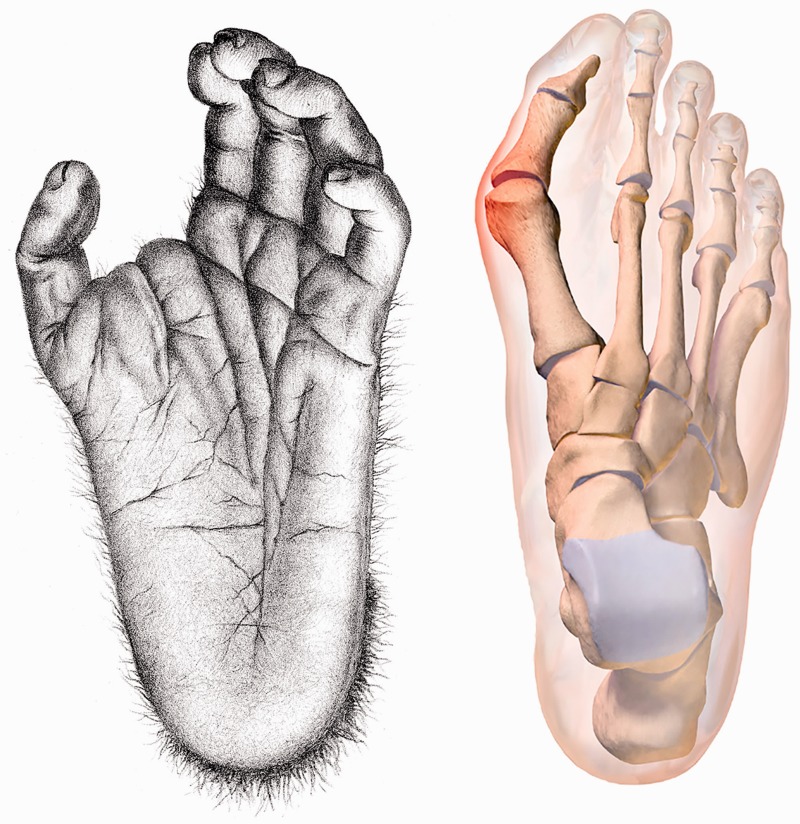 Grasping primate foot with abducent hallux (left); hallux valgus in humans (right)
